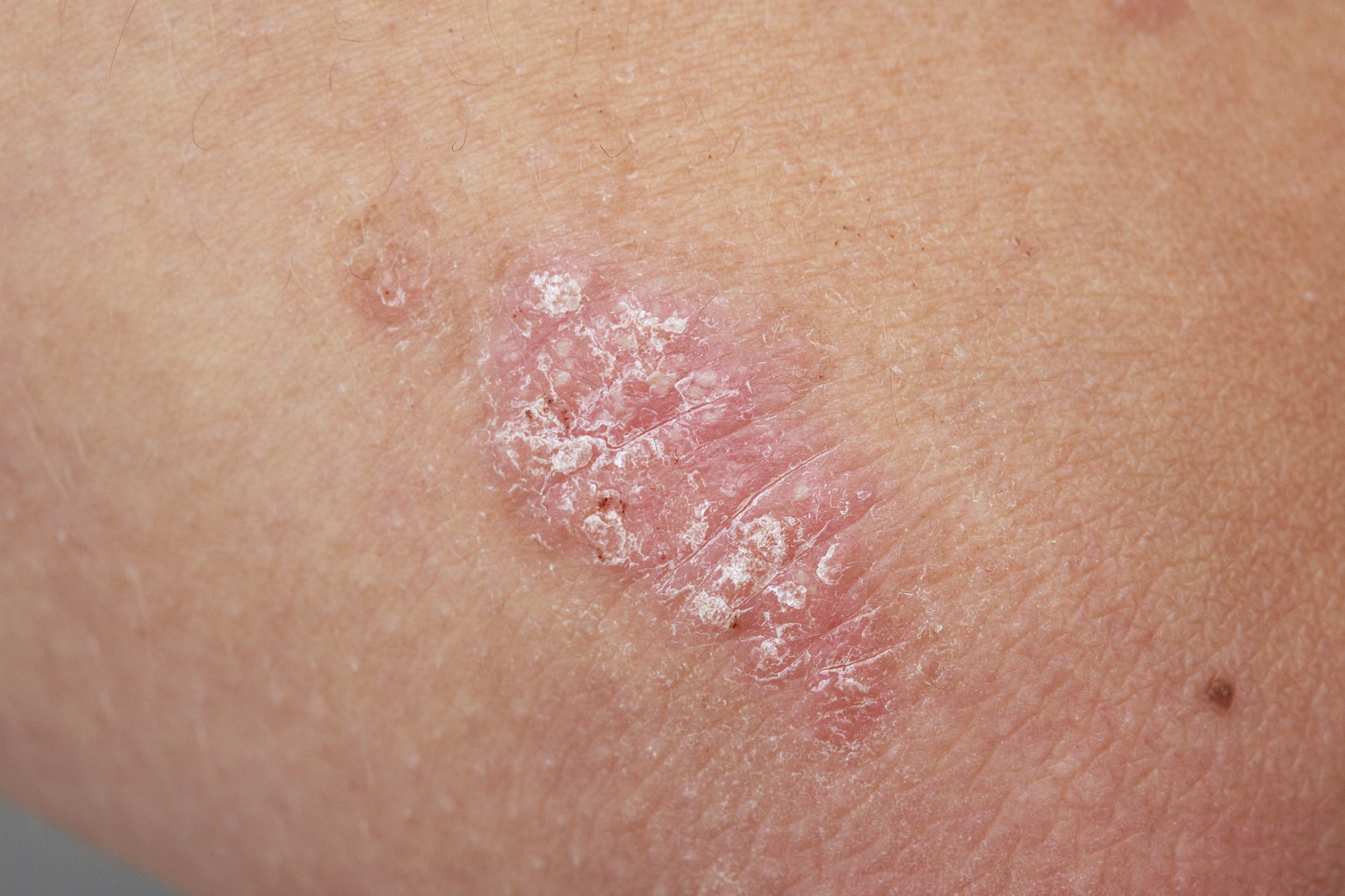 psoriasis sur la peau