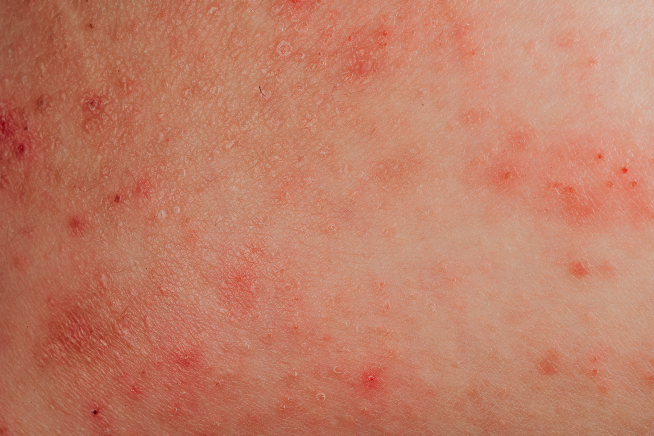 allergie à l'eczéma sur la peau